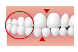 交叉咬合(こうさこうごう)